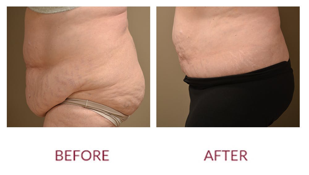Tummy Tuck Before & After Gallery - Patient 46142298 - Image 2