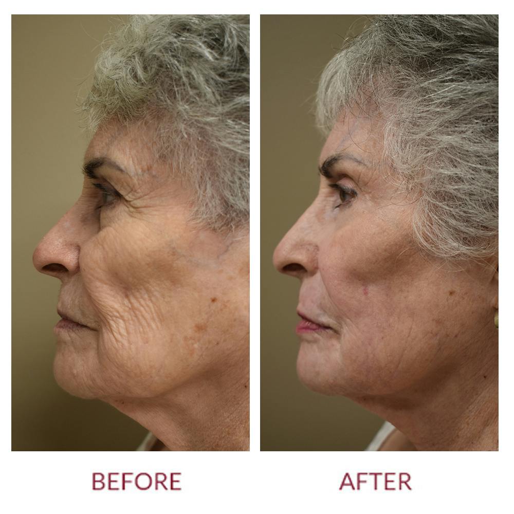 Laser Resurfacing Before & After Gallery - Patient 46165580 - Image 2