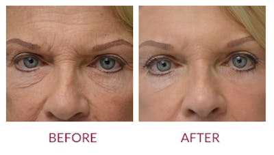 Laser Resurfacing Before & After Gallery - Patient 46165582 - Image 2