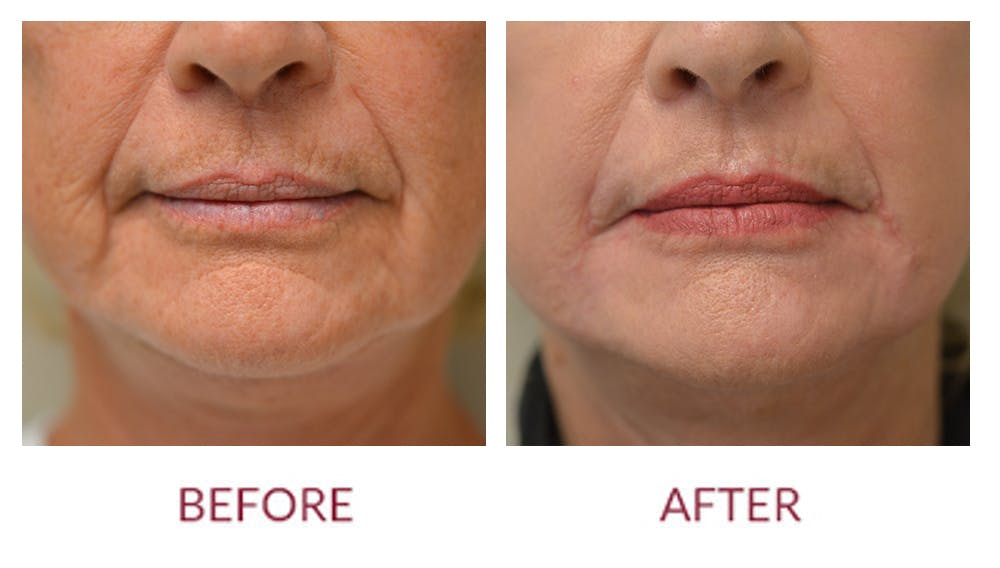 Laser Resurfacing Before & After Gallery - Patient 46165582 - Image 3
