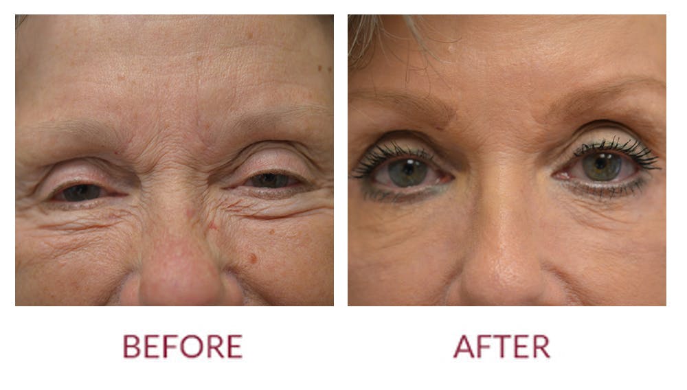 Laser Resurfacing Before & After Gallery - Patient 46165596 - Image 2