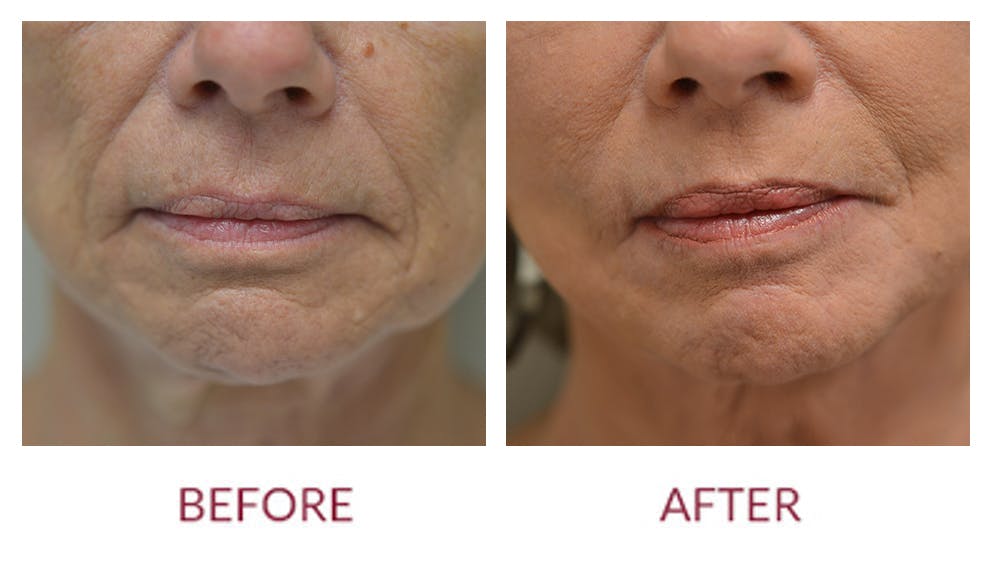 Laser Resurfacing Before & After Gallery - Patient 46165596 - Image 3