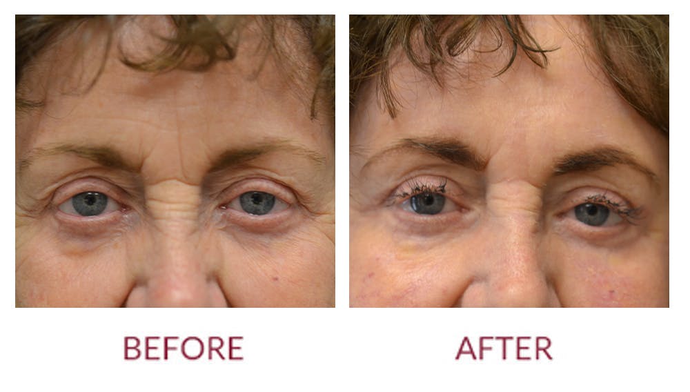 Eyelid Surgery Gallery - Patient 46165605 - Image 2