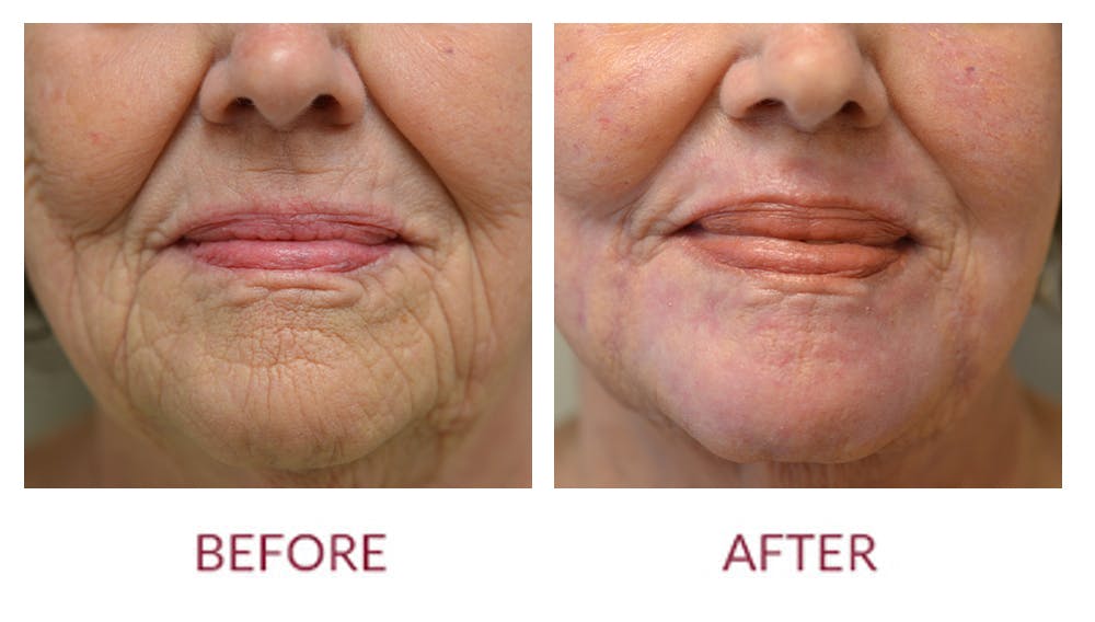 Eyelid Surgery Before & After Gallery - Patient 46165605 - Image 3
