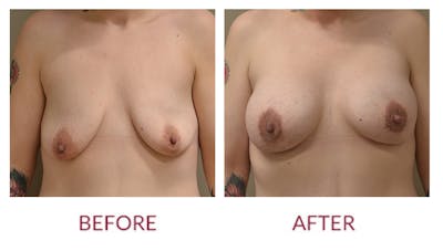 Breast Augmentation Before & After Gallery - Patient 46165611 - Image 1