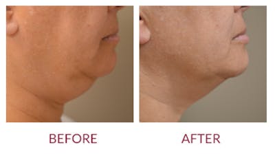 Chin Augmentation Before & After Gallery - Patient 46165616 - Image 1