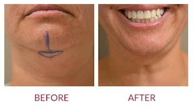 Chin Augmentation Before & After Gallery - Patient 46165616 - Image 2