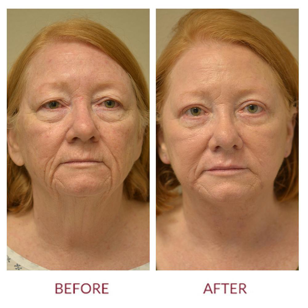 Co2 Laser Resurfacing Before & After Gallery - Patient 106369401 - Image 1