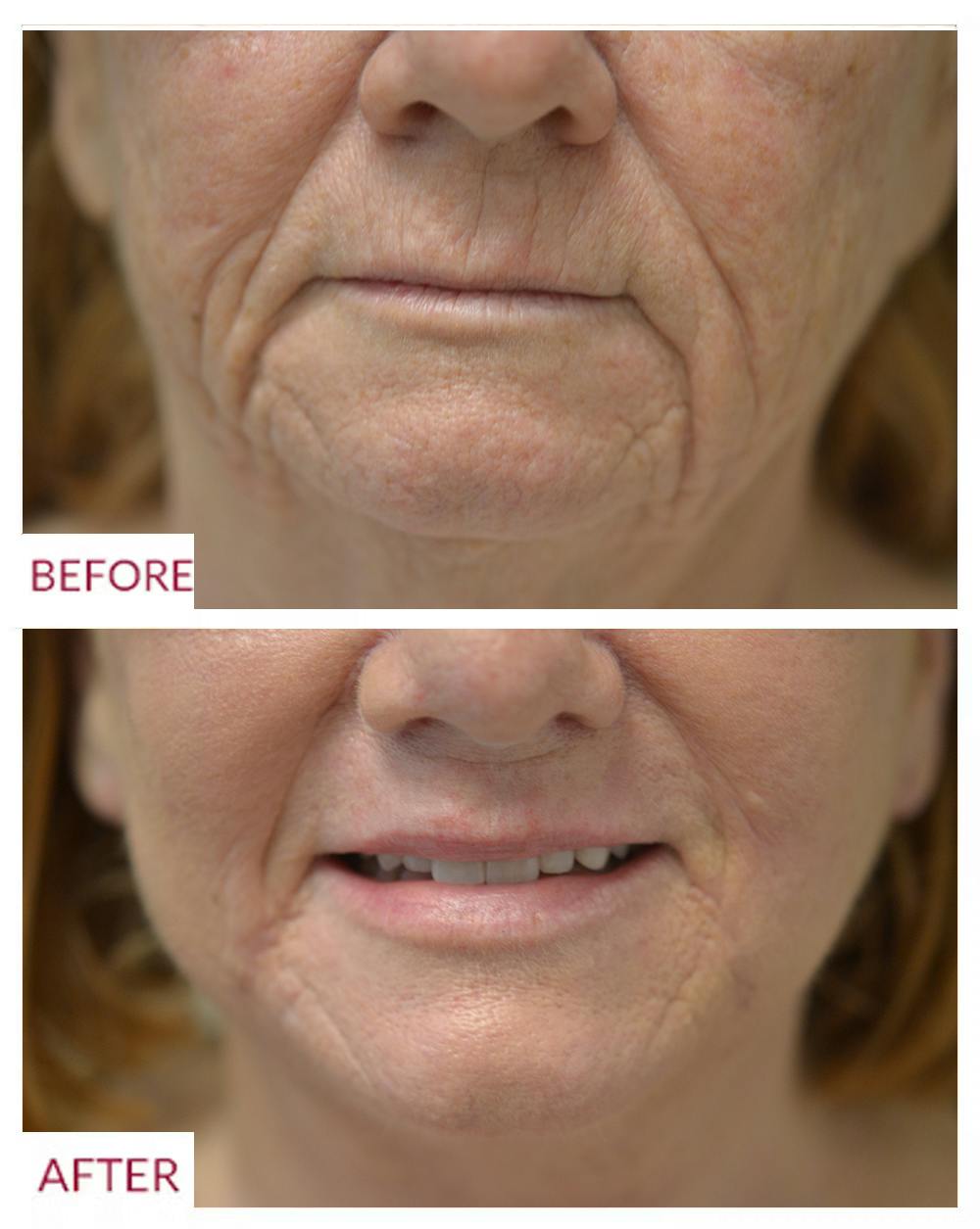 Co2 Laser Resurfacing Before & After Gallery - Patient 106369402 - Image 1