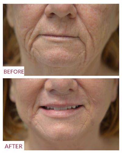 Co2 Laser Resurfacing Before & After Gallery - Patient 106369402 - Image 1
