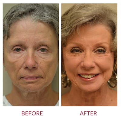 Facelift Before & After Gallery - Patient 106369419 - Image 1