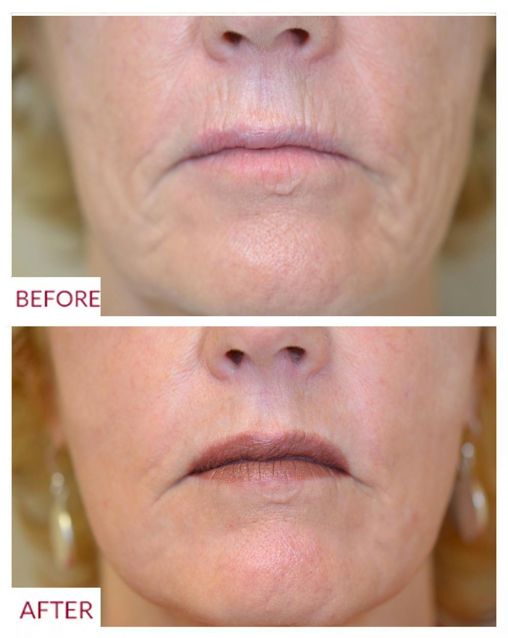 Lip Fillers Before & After Gallery - Patient 106369445 - Image 1