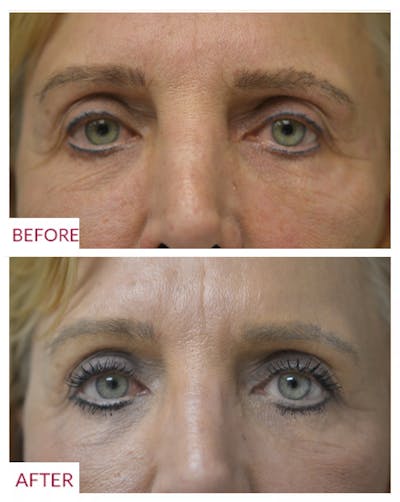 Eyelid Surgery Before & After Gallery - Patient 106369458 - Image 1