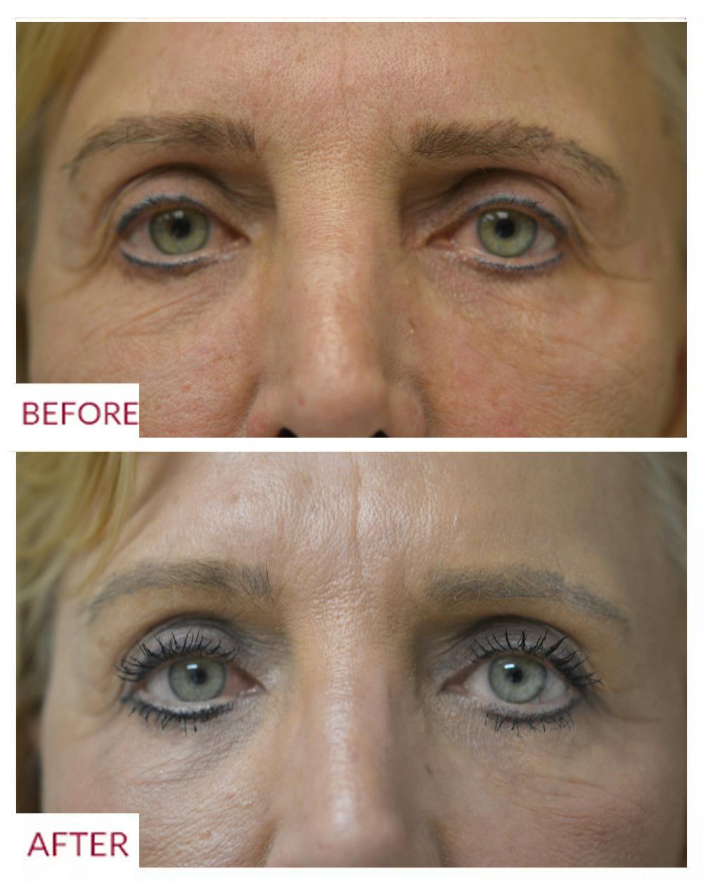 Eyelid Surgery Gallery - Patient 106369458 - Image 1