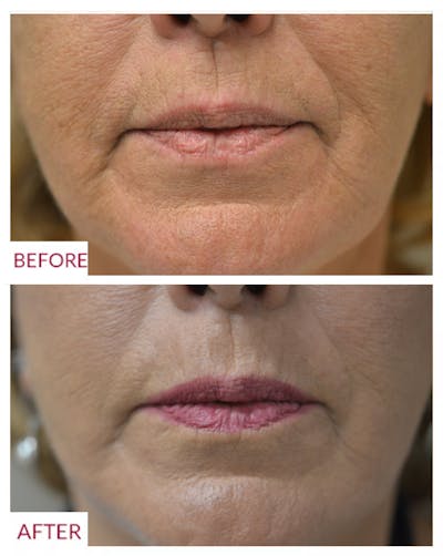 Lip Fillers Before & After Gallery - Patient 106369484 - Image 1