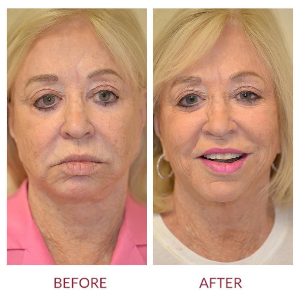 Facelift Before & After Gallery - Patient 106369512 - Image 1