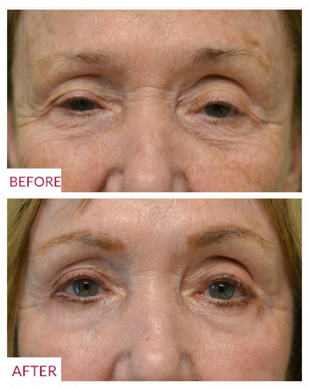 Eyelid Surgery Before & After Gallery - Patient 106369660 - Image 1