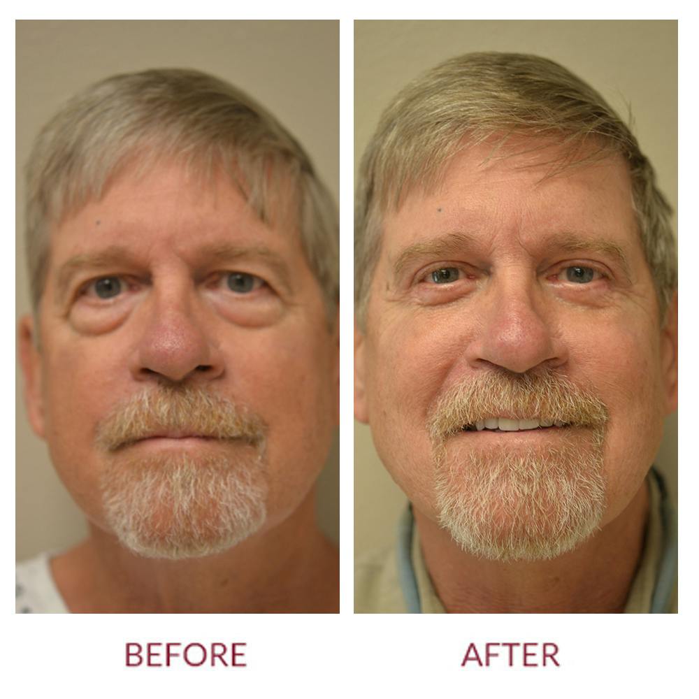 Facelift Before & After Gallery - Patient 106369667 - Image 1