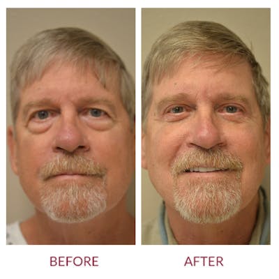Facelift Before & After Gallery - Patient 106369667 - Image 1