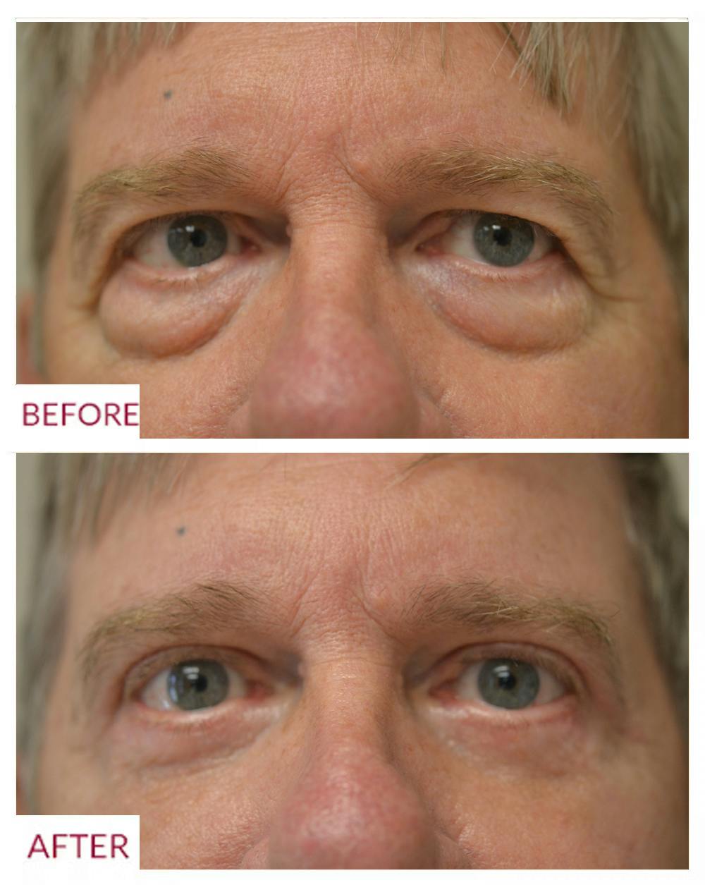 Facelift Before & After Gallery - Patient 106369667 - Image 2