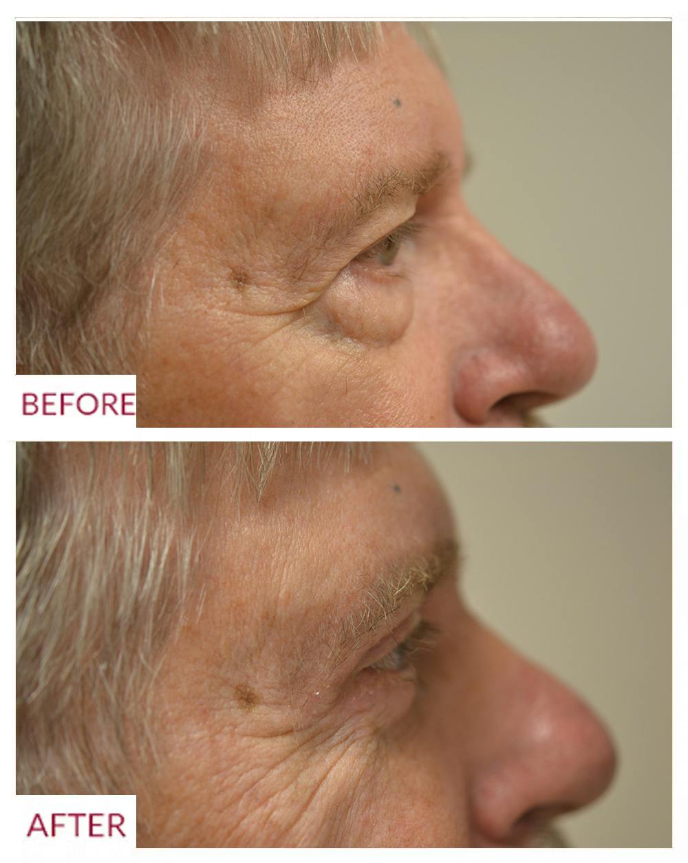 Facelift Before & After Gallery - Patient 106369667 - Image 3
