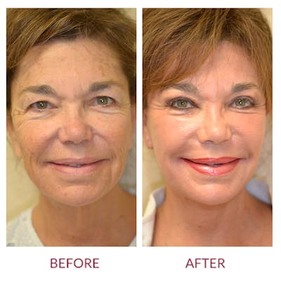 Co2 Laser Resurfacing Before & After Gallery - Patient 106369730 - Image 1