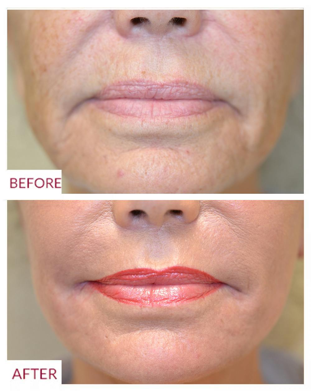Co2 Laser Resurfacing Before & After Gallery - Patient 106369730 - Image 2