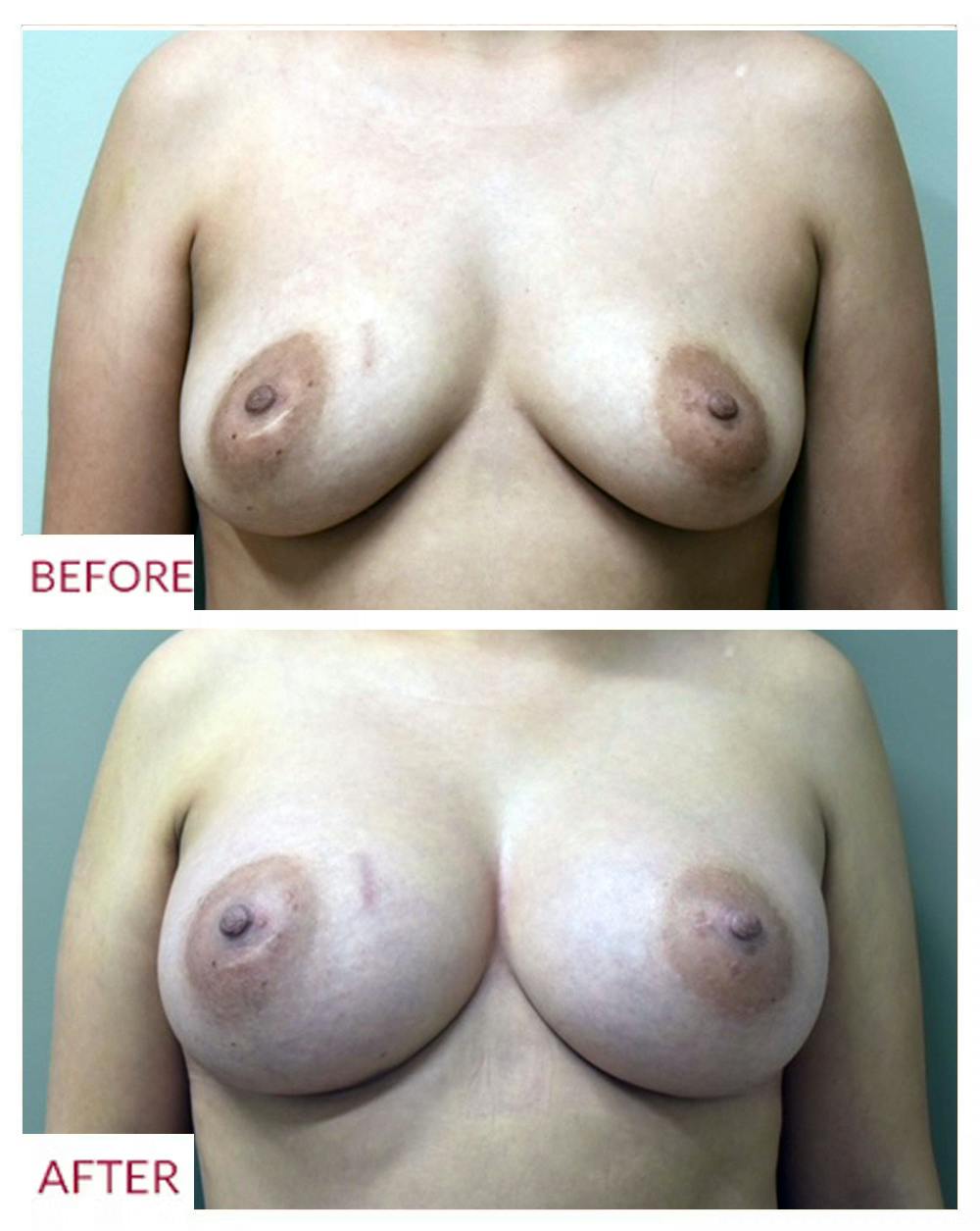 Breast Augmentation Before & After Gallery - Patient 106369751 - Image 1