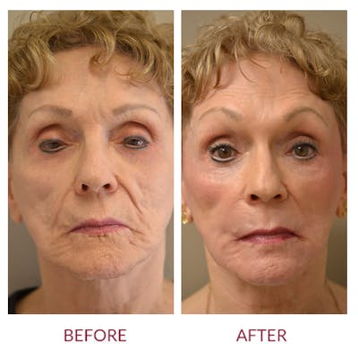 Co2 Laser Resurfacing Before & After Gallery - Patient 107344366 - Image 1