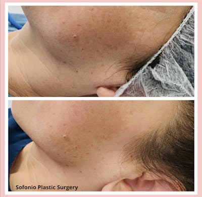 Perfect Peel Before & After Gallery - Patient 122245338 - Image 1