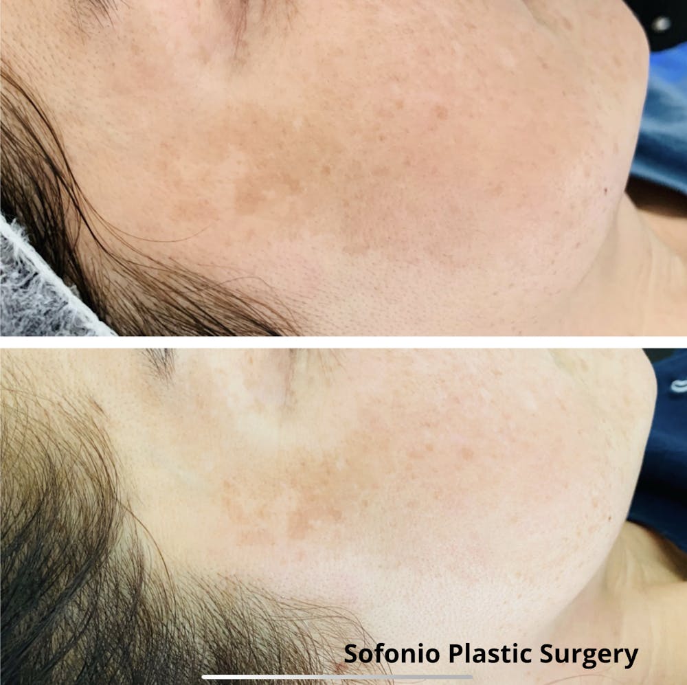Perfect Peel Before & After Gallery - Patient 122245339 - Image 1