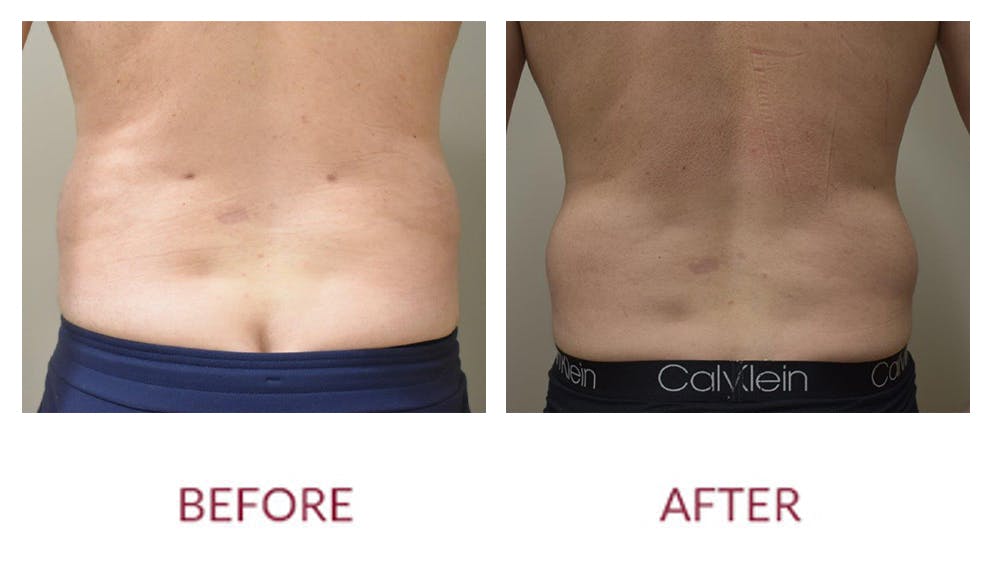 Liposuction Before & After Gallery - Patient 123012017 - Image 1