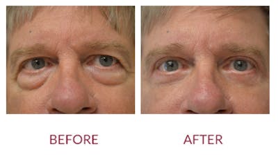 Eyelid Surgery Before & After Gallery - Patient 123012081 - Image 1