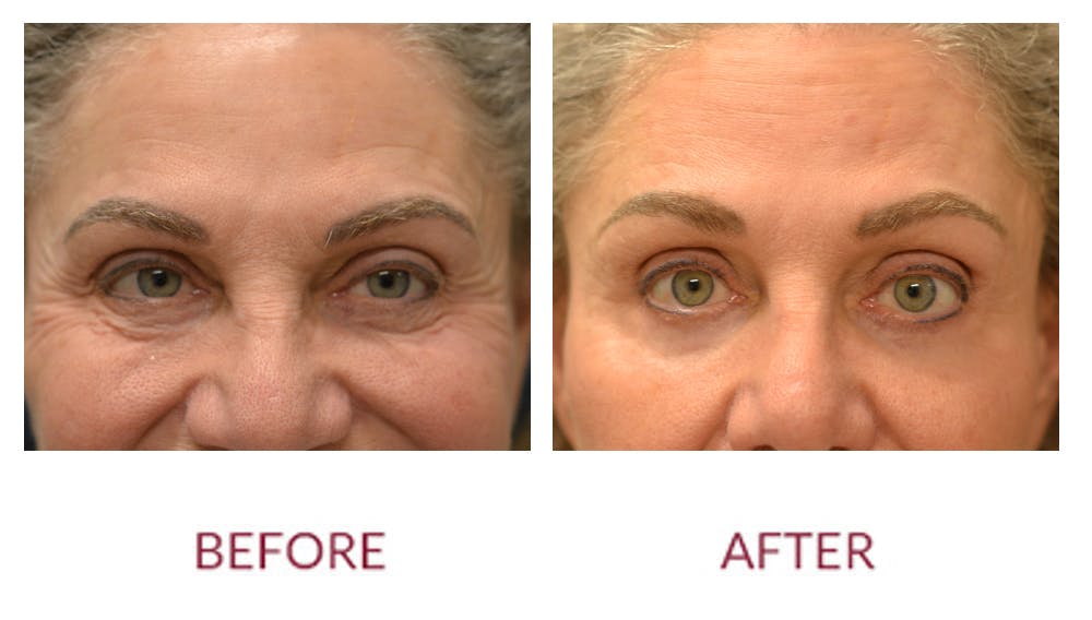 Eyelid Surgery Before & After Gallery - Patient 123012082 - Image 1