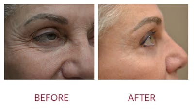 Eyelid Surgery Before & After Gallery - Patient 123012082 - Image 2