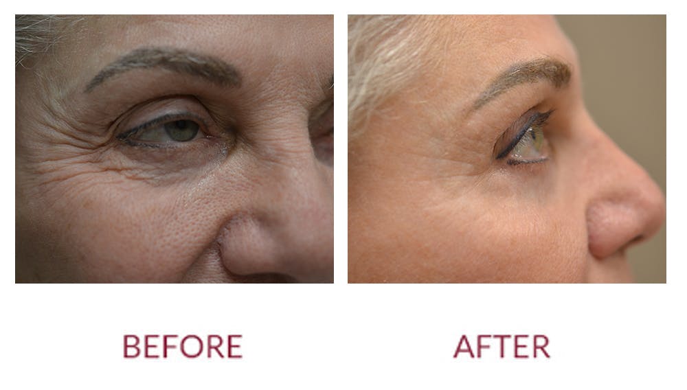 Eyelid Surgery Before & After Gallery - Patient 123012082 - Image 2