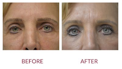 Eyelid Surgery Before & After Gallery - Patient 123012083 - Image 1