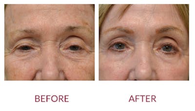 Eyelid Surgery Before & After Gallery - Patient 123012084 - Image 1