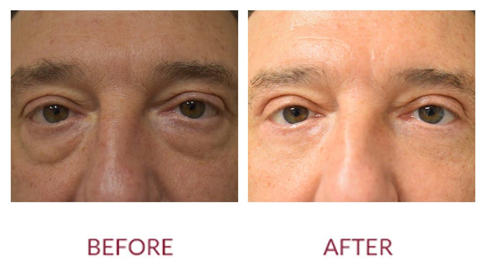 Eyelid Surgery Before & After Gallery - Patient 123012085 - Image 1