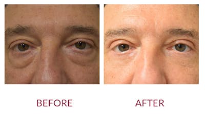 Eyelid Surgery Before & After Gallery - Patient 123012085 - Image 1