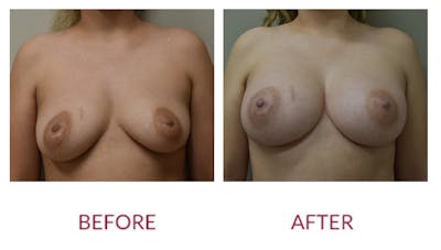 Breast Augmentation Before & After Gallery - Patient 123012094 - Image 1