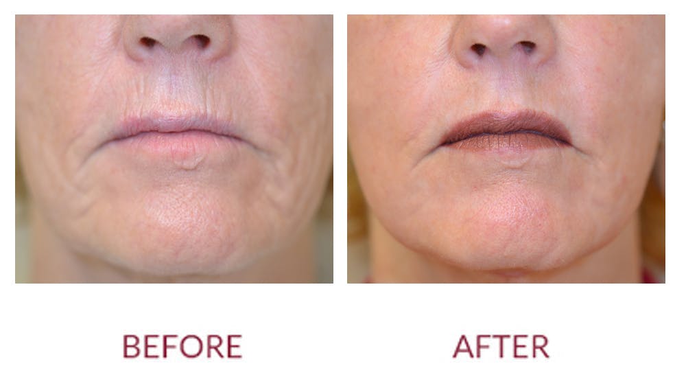 Co2 Laser Resurfacing Before & After Gallery - Patient 123012097 - Image 1