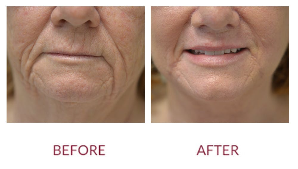Co2 Laser Resurfacing Before & After Gallery - Patient 123012098 - Image 1