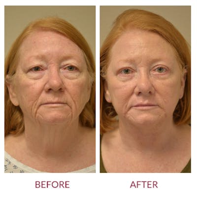 Facelift Before & After Gallery - Patient 123012166 - Image 1