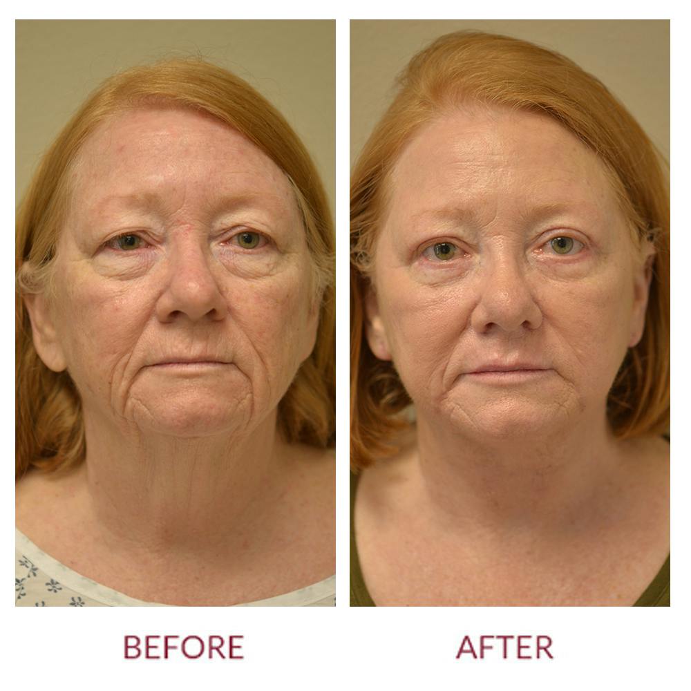 Facelift Before & After Gallery - Patient 123012166 - Image 1