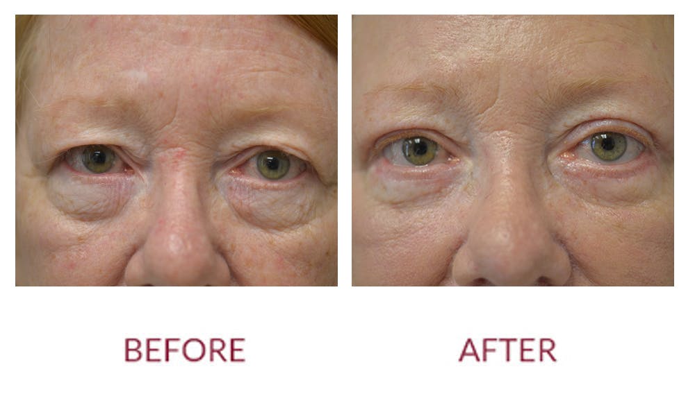 Facelift Before & After Gallery - Patient 123012166 - Image 3