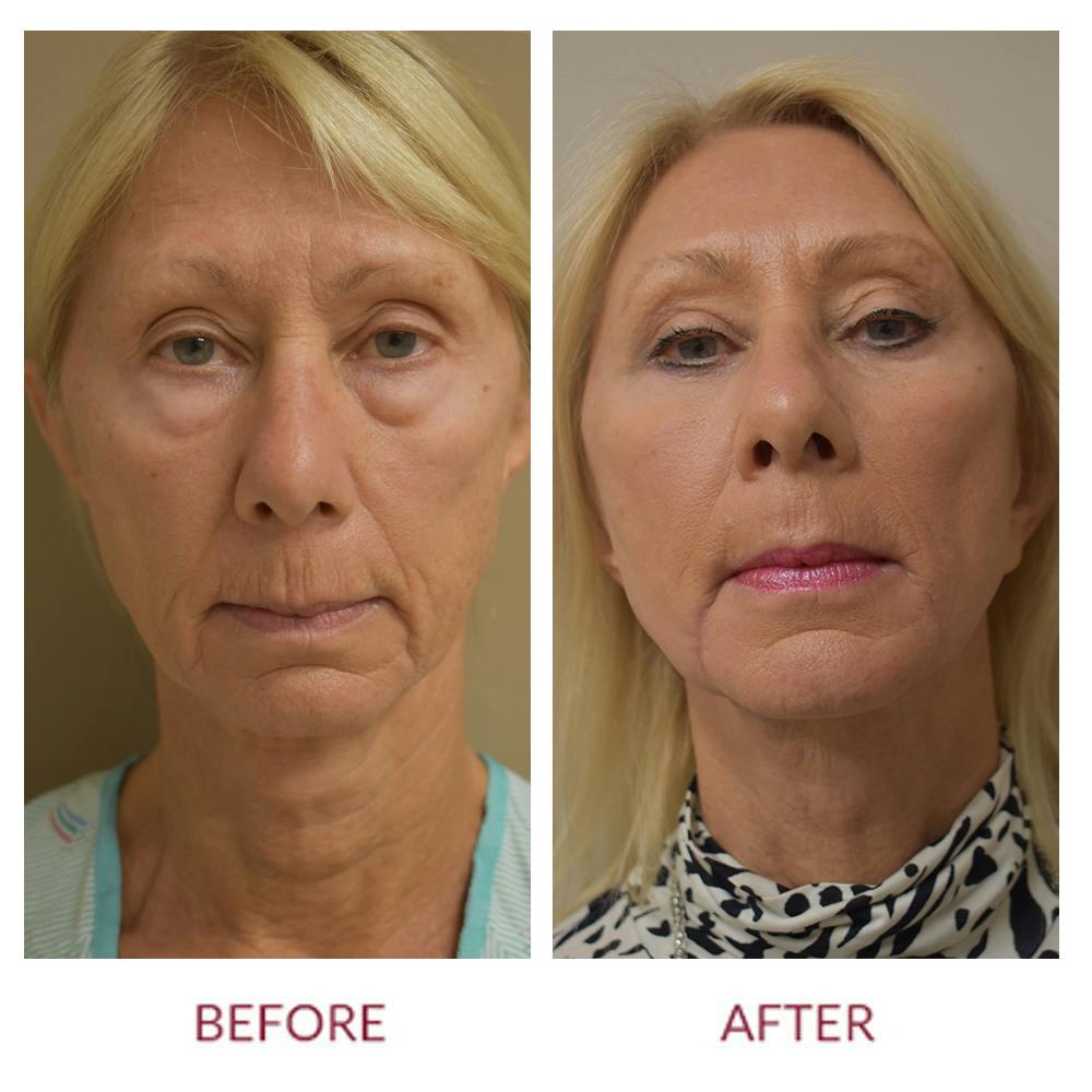 Facelift Before & After Gallery - Patient 123012167 - Image 1