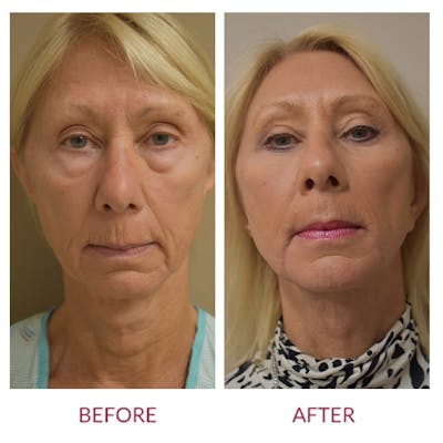 Facelift Before & After Gallery - Patient 123012167 - Image 1