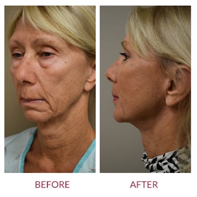 Facelift Before & After Gallery - Patient 123012167 - Image 2
