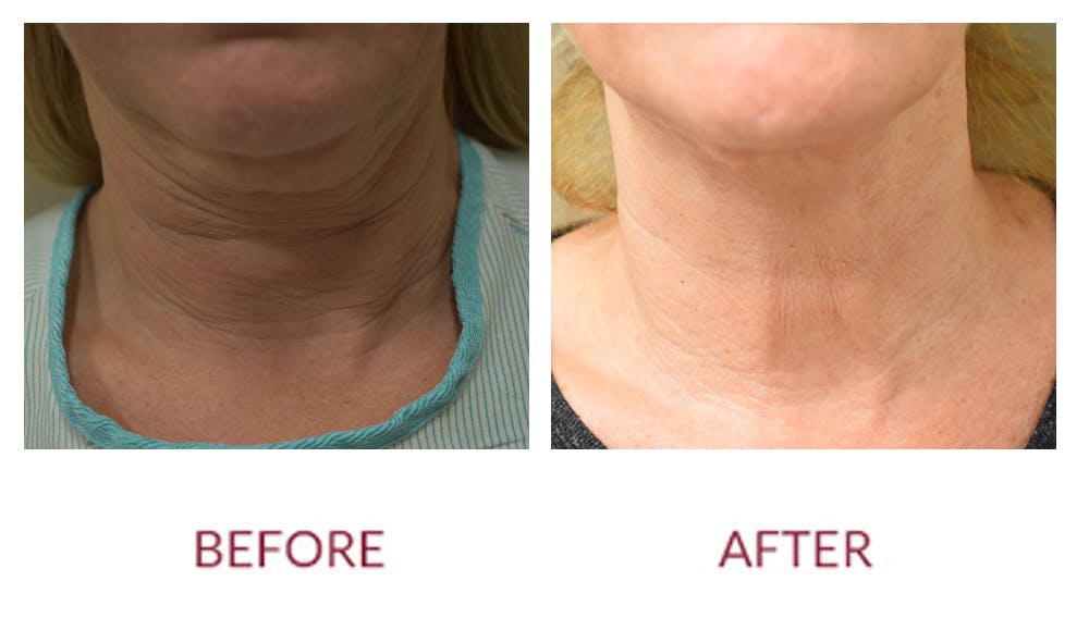 Facelift Before & After Gallery - Patient 141136284 - Image 2